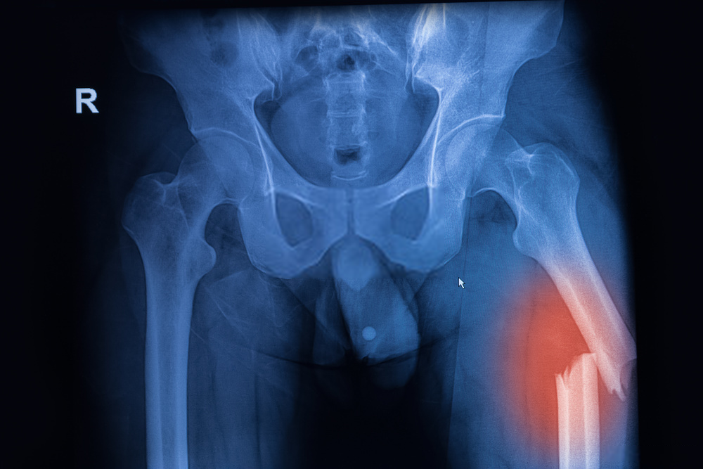 Prevent Osteoporosis