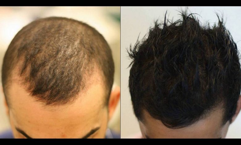 prp hair los angeles