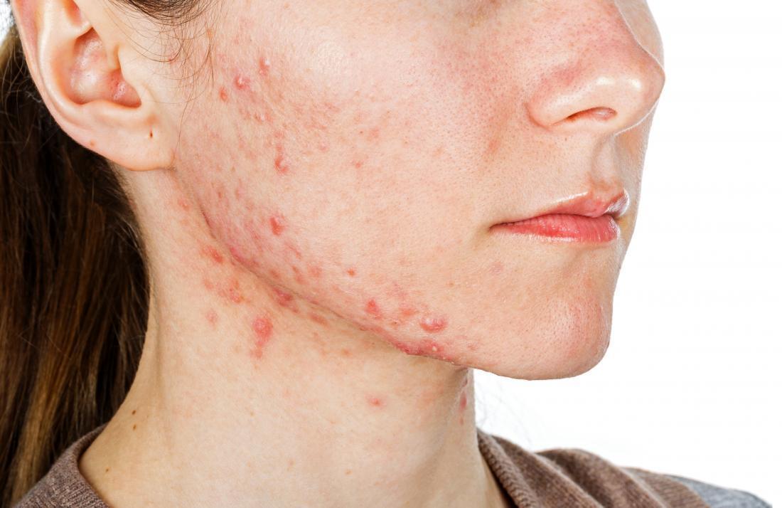 acne scars treatments