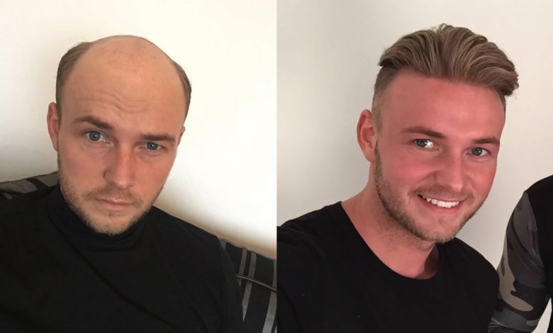hair replacement system