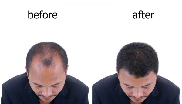 Before After Hair Transplant