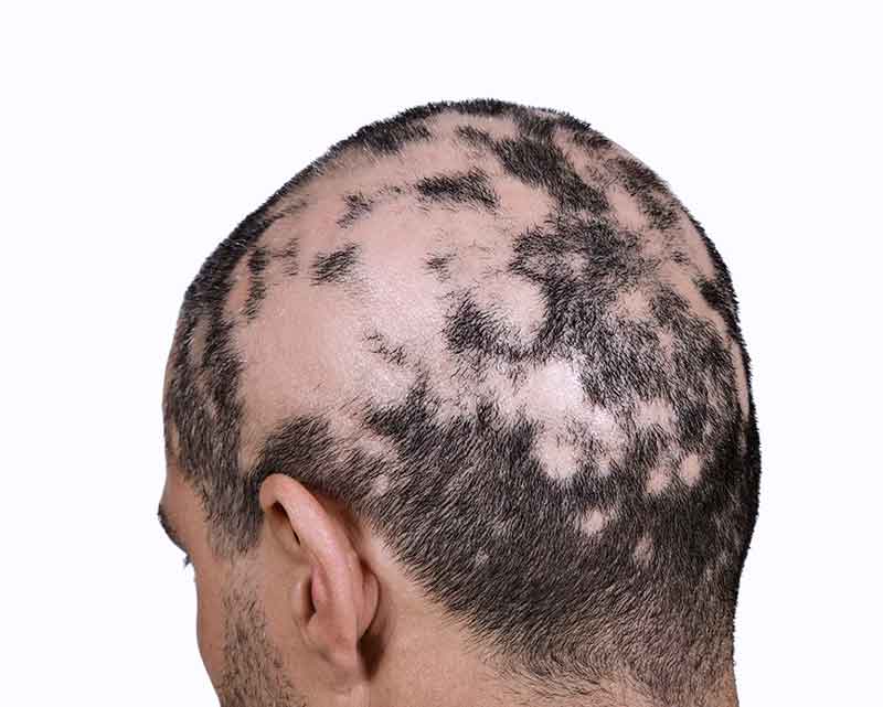 alopecia areata