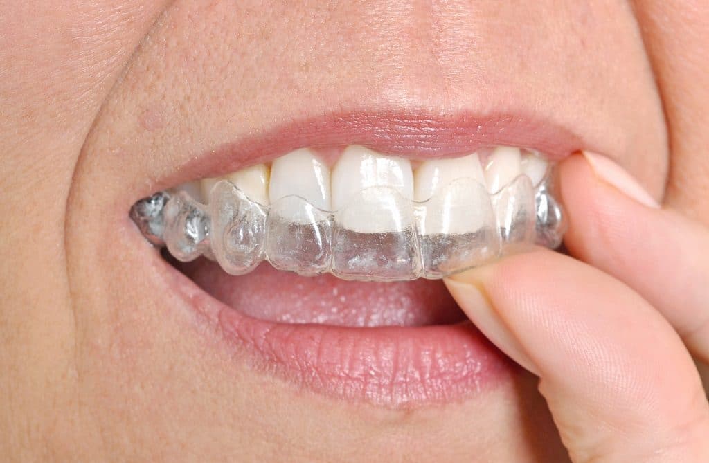 Clear Teeth Aligners