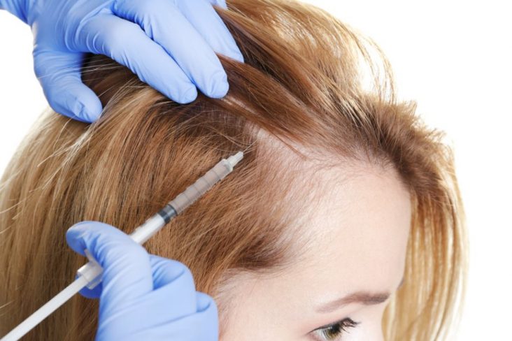 Benefits of PRP Treatment For Hair