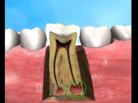 root canal treatment