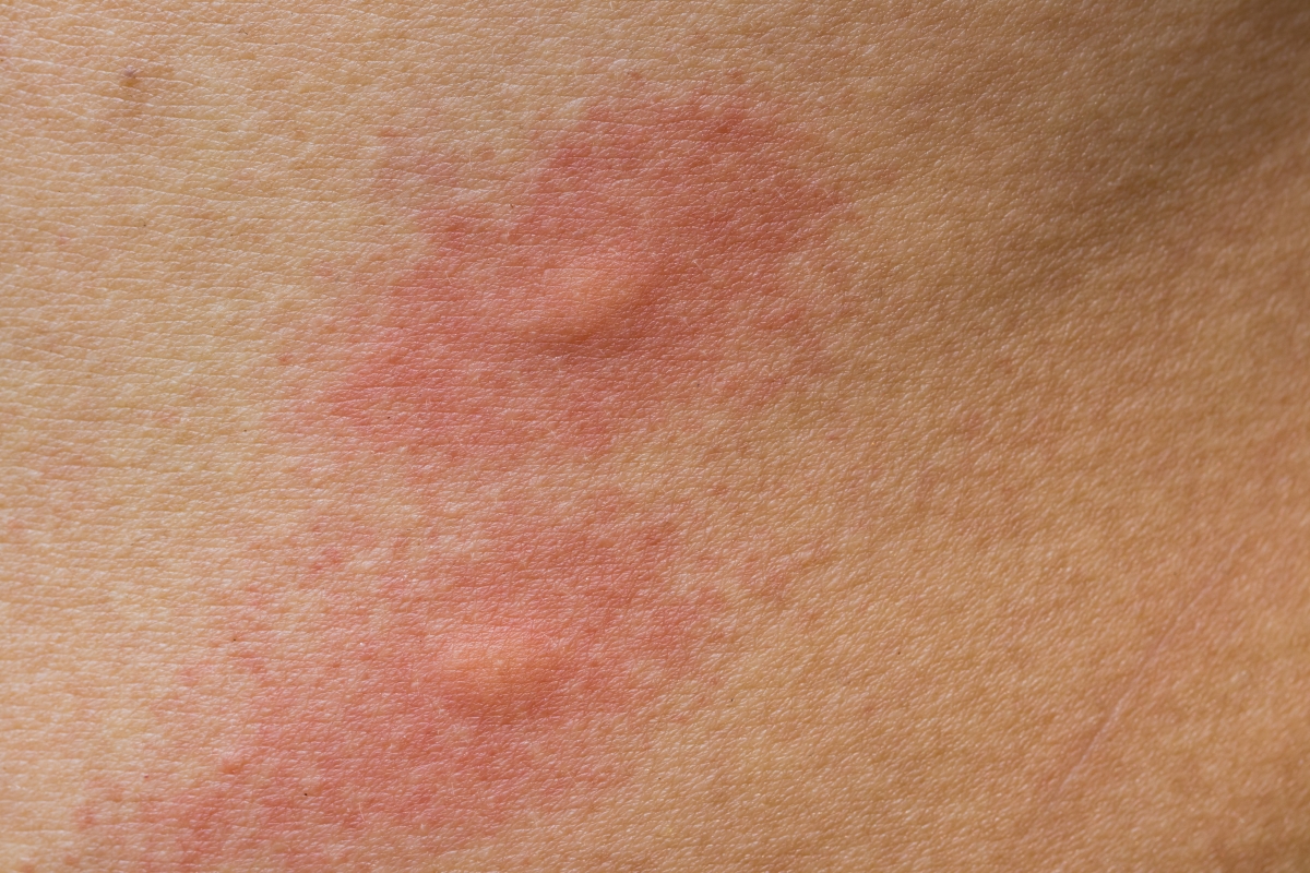 Contact Dermatitis