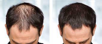 Hair transplant cost in Jaipur