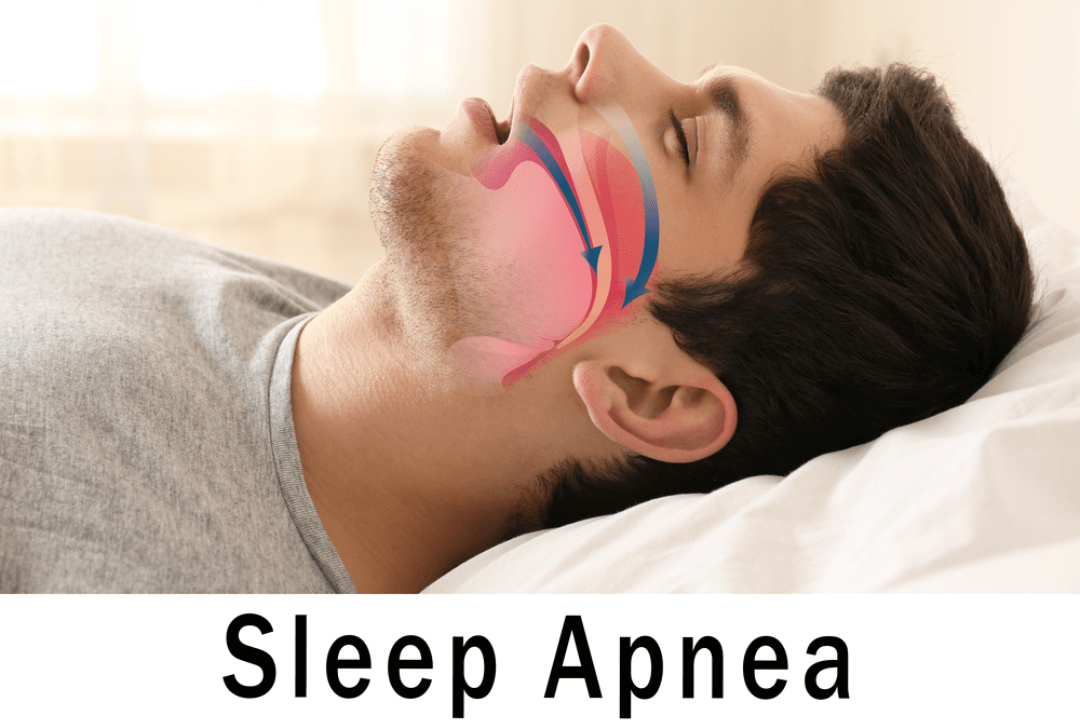 Sleep apnea