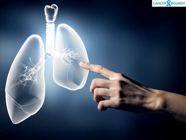 lung cancer