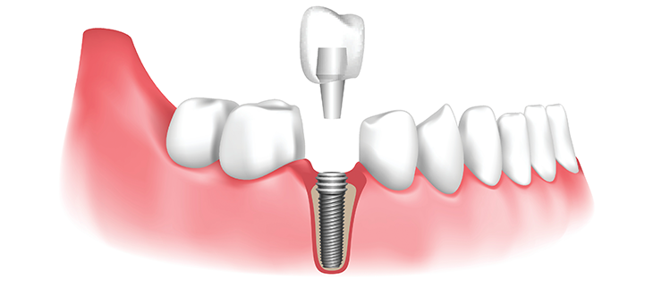 dental implants in London