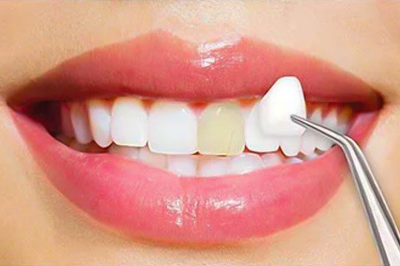 Veneers Toronto
