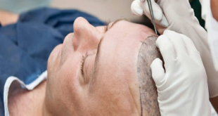 DHI Hair Transplant Procedure: Benefits, Side Effects. How Does It Work In Dubai?