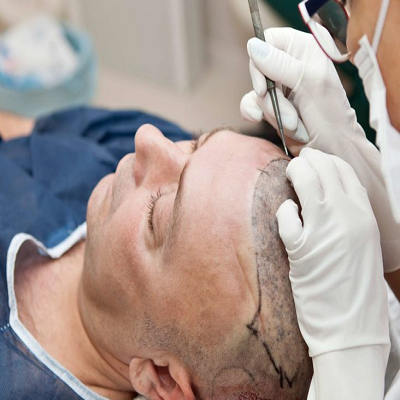 DHI Hair Transplant Procedure: Benefits, Side Effects. How Does It Work In Dubai?